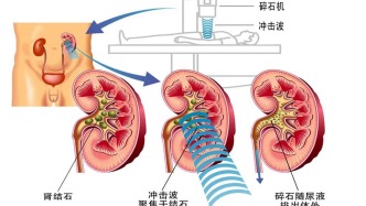 體外沖擊波碎石術丨“隔山打?！蓖呓狻隘偪竦氖^”