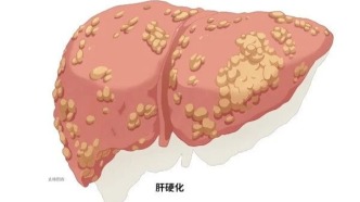 肝硬化悄然來襲：揭秘癥狀、深挖成因，守護(hù)肝臟健康