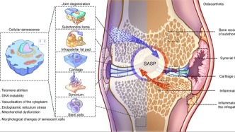 医工简报 | 炎症与细胞衰老的相互作用：对骨关节炎发生和进展的新见解