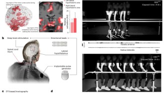Nature Medicine | 深腦電刺激外側下丘腦可以幫助癱瘓患者恢復行走能力
