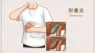 “膽”小事大——關于膽囊炎你了解多少？