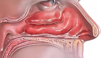 鼻咽癌容易与普通鼻炎、感冒混淆