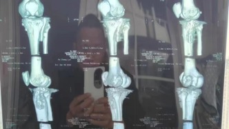 騎手摔倒致殘勞務(wù)公司被判賠十萬(wàn)上訴，澎湃報(bào)道后已申請(qǐng)撤訴