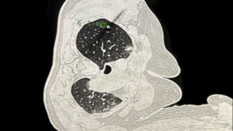肺部穿刺导航机器人在沪投用，手术时间从半小时缩至10分钟