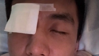 遭遇生命中最恐懼一刻，郭艾倫右眼球縫了40多針