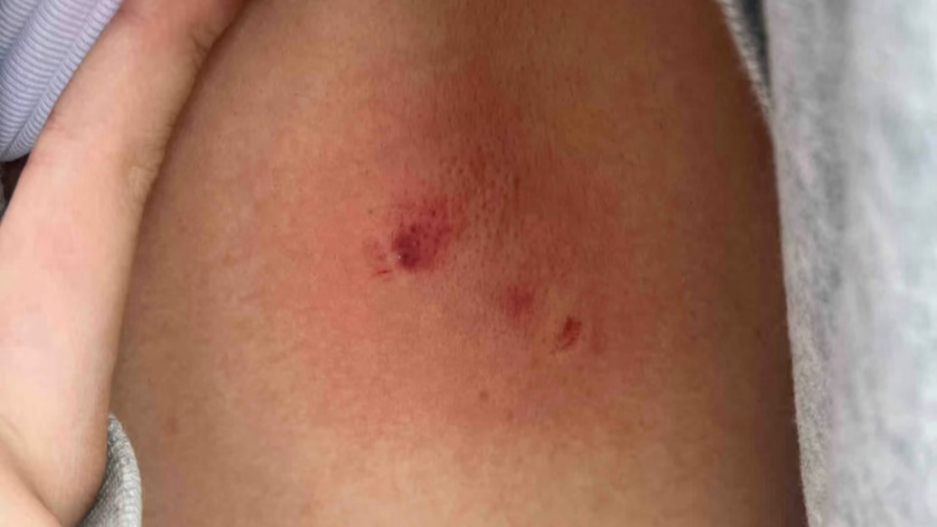 黔灵山公园回应猕猴咬伤游客背部：狂犬疫苗费用可报销，猕猴分流被迫中止