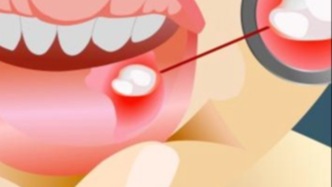 復發(fā)性口腔潰瘍?nèi)菀妆徽`診嗎？若這些分數(shù)加起來大于4，很可能是白塞病