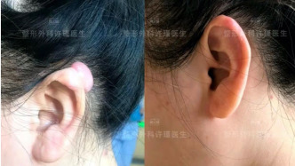 科普｜“小”耳洞也会引发“大”疙瘩，如何治疗和预防？