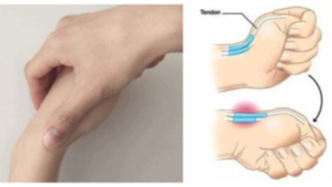 腱鞘炎名中醫(yī)施刀除痛未果