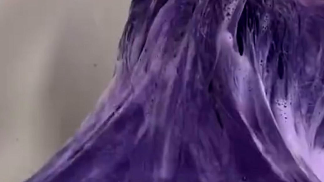 女生持续2年每月漂染头发后确诊紫癜性肾炎，需剃光头发治疗