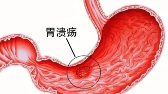 胃潰瘍，無論看起來有多“善良”，也必須取活檢