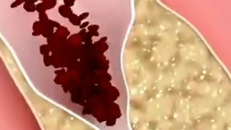 34岁女子爱生闷气，一根血管竟堵塞90%