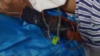 保安被狗咬傷手部大面積撕裂，女兒：犬主墊付了1萬元醫(yī)藥費