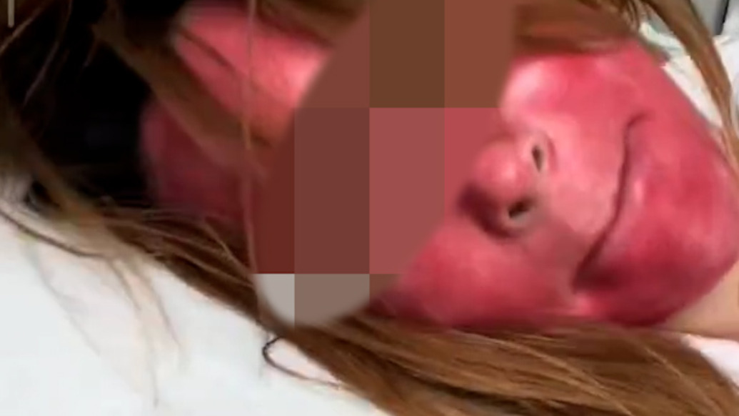 女子自称因22年晚上不卸妆，脸部严重过敏红成“关公”