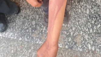 邵阳一男童遭虐待致轻伤二级：生父已被刑拘，检察院提前介入