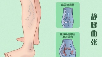 科普｜蚯蚓腿，红血丝背后的秘密