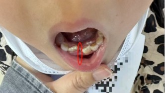 昆明7歲女童拔乳牙時(shí)被錯(cuò)拔恒牙，診所：家長(zhǎng)指定堅(jiān)持要拔