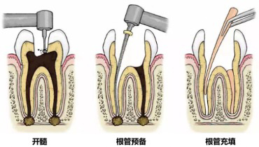 科普｜“根管治疗”是什么？如何保护好自己的牙齿？ 第2张