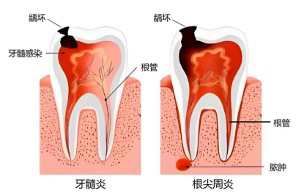 科普｜“根管治疗”是什么？如何保护好自己的牙齿？ 第3张