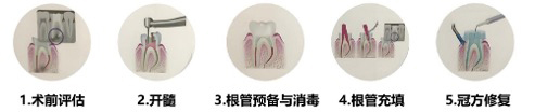 科普｜“根管治疗”是什么？如何保护好自己的牙齿？ 第4张
