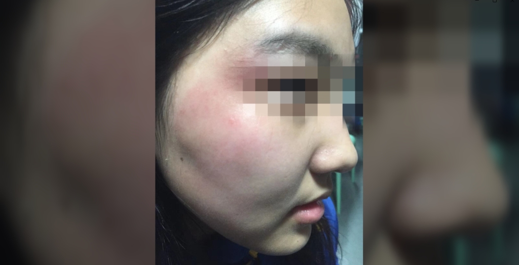 武汉17岁女生与男同学冲突中被打致颅脑损伤，学校：多部门已介入处理