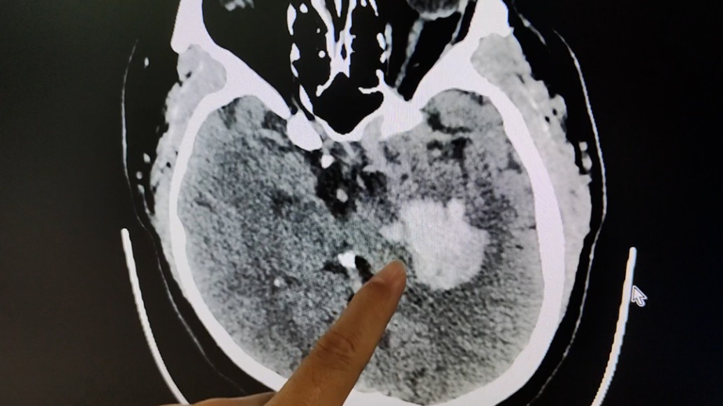 250斤小伙熬夜打游戲后突發腦出血