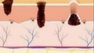 如何区分黑色素痣的良与恶：读懂皮肤上的“危险信号”