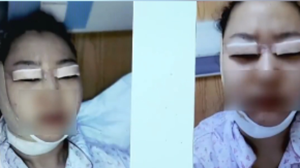 女子花5萬元醫(yī)美動刀后0變化，割的雙眼皮竟完全消失