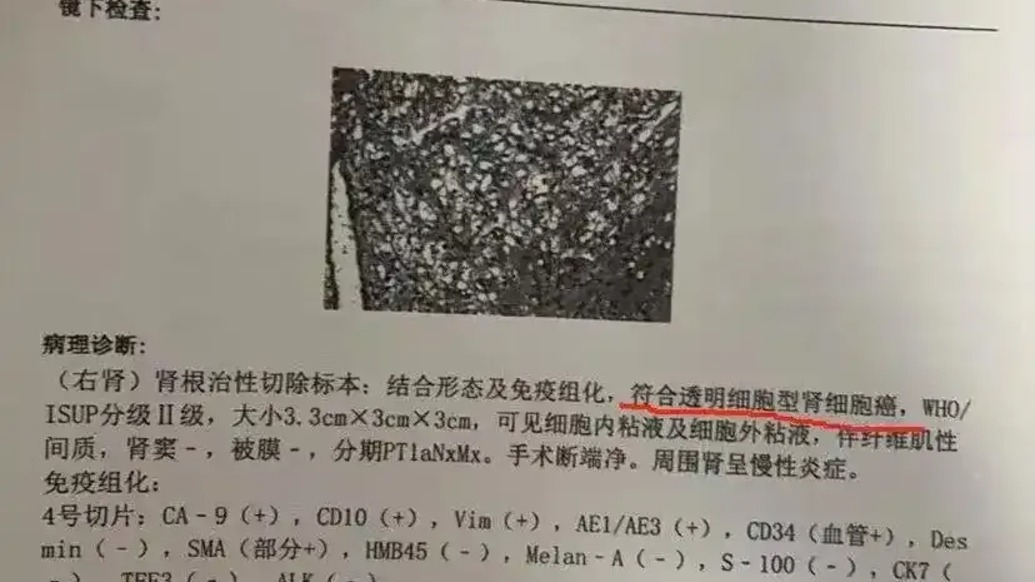 体检10年未预警却患癌症，每年体检是否还有意义？