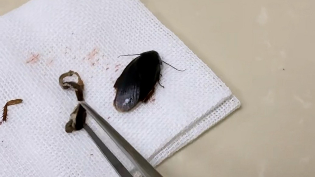 大黑虫钻入女子耳道,医生灌麻药取出