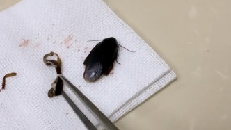 大黑蟲鉆入女子耳道，醫(yī)生灌麻藥取出