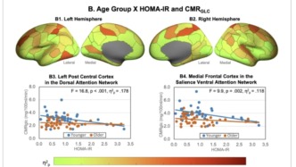 血糖的每一次飆升，都在讓你的大腦慢慢變笨