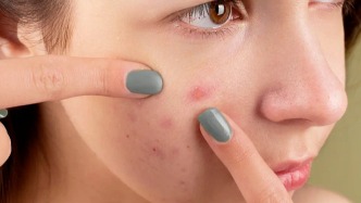 科普解颐｜“痘印痘坑”暑期激光攻略战