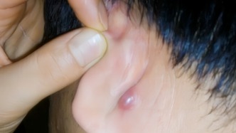 耳朵后面摸到的小疙瘩，到底是個啥？