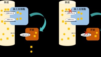 谷固醇病例分享：歷經(jīng)周折，血小板減少的“罪魁禍首”竟然是“高血脂”