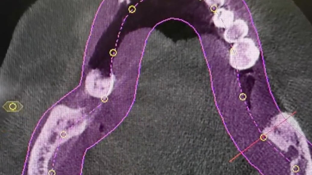 老人口腔门诊治疗后身亡,女儿称拔了12颗牙种植6颗卫健部门介入