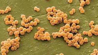 浙江53岁女子听信偏方感染超级细菌