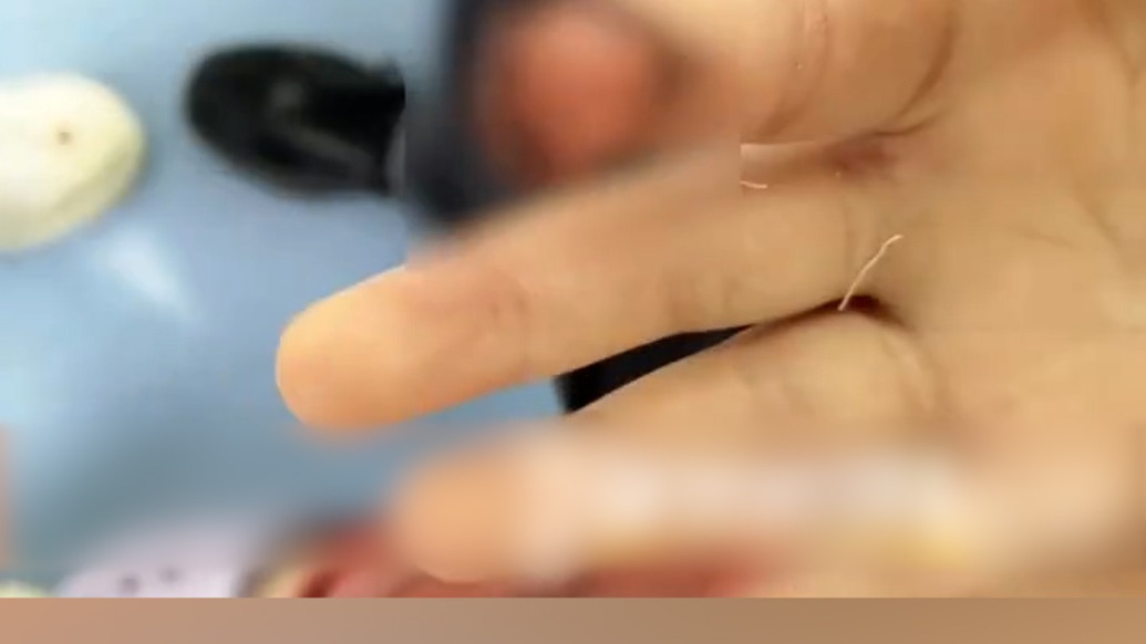 7歲女童被馬咬傷手指，度假區(qū)：承擔(dān)所有醫(yī)療費(fèi)，并支付賠償