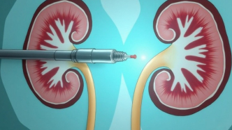 輸尿管軟鏡聯(lián)合負(fù)壓鞘：腎結(jié)石治療的“微創(chuàng)吸塵器”革命