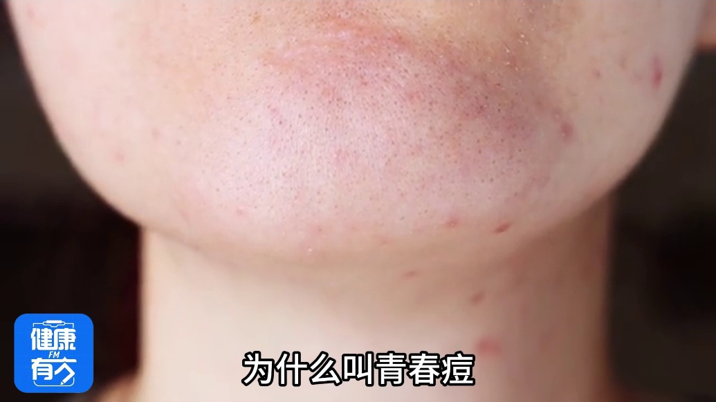 油痘肌必看！什么原因会导致长痘？｜健康有方FM