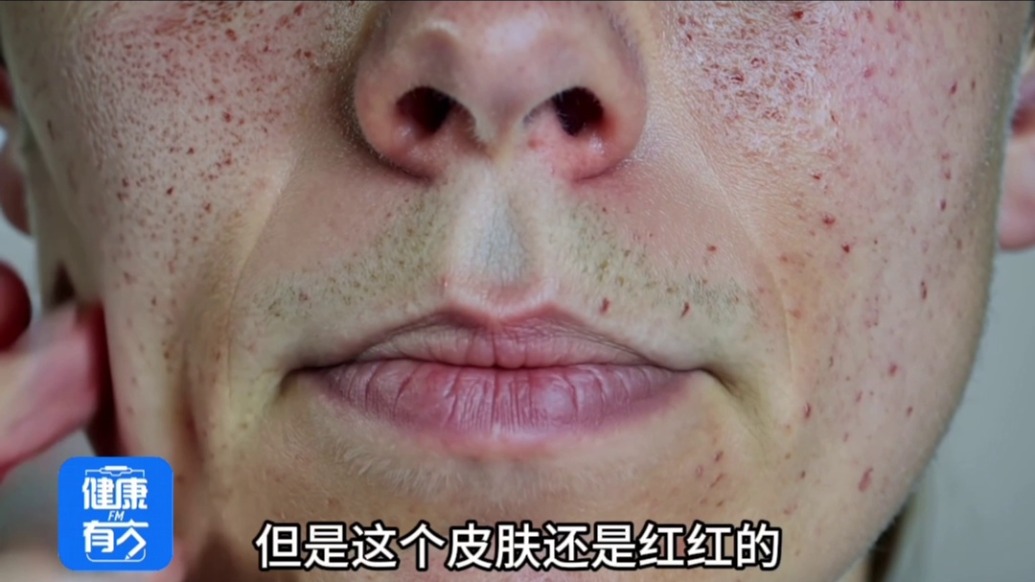 难搞的痘印,究竟怎样才能消除?|健康有方FM