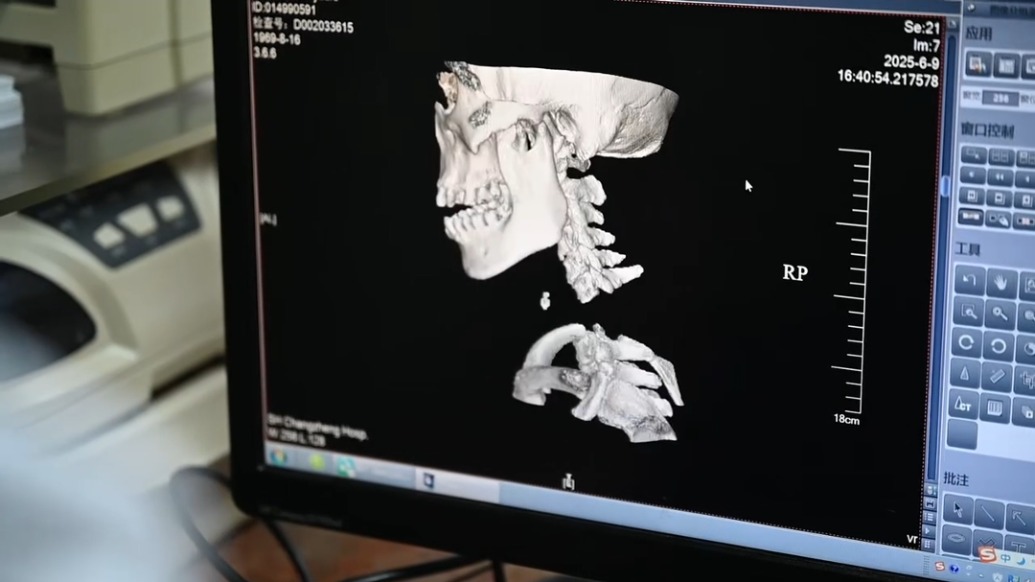 “在一個(gè)永不放棄的信念下”，上海醫(yī)生救回“身首離斷”患者