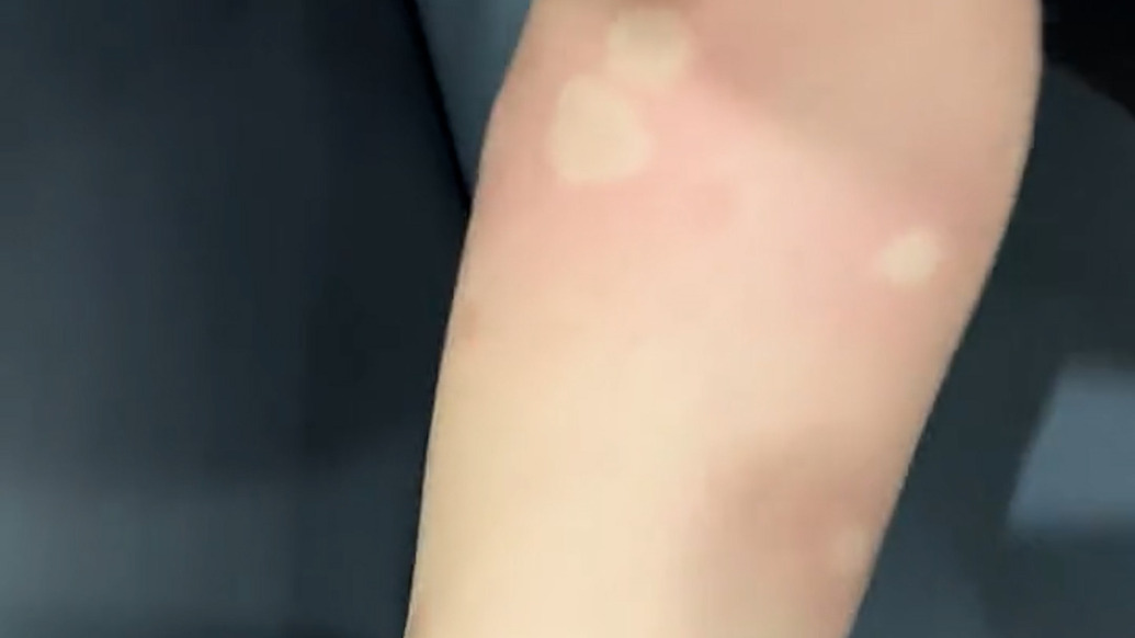 廣西玉林市玉州區(qū)通報發(fā)現(xiàn)1例基孔肯雅熱外市輸入病例：已得到有效診治