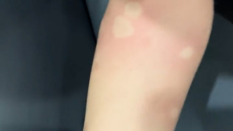 廣西玉林市玉州區(qū)通報(bào)發(fā)現(xiàn)1例基孔肯雅熱外市輸入病例：已得到有效診治