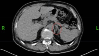 十年血壓達標(biāo)背后，隱藏的“真兇”竟是它！