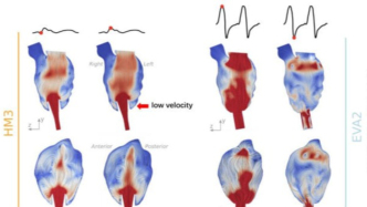 榮獲國(guó)際獎(jiǎng)項(xiàng)，國(guó)產(chǎn)人工心臟兩項(xiàng)技術(shù)創(chuàng)新減少近五成血液停滯