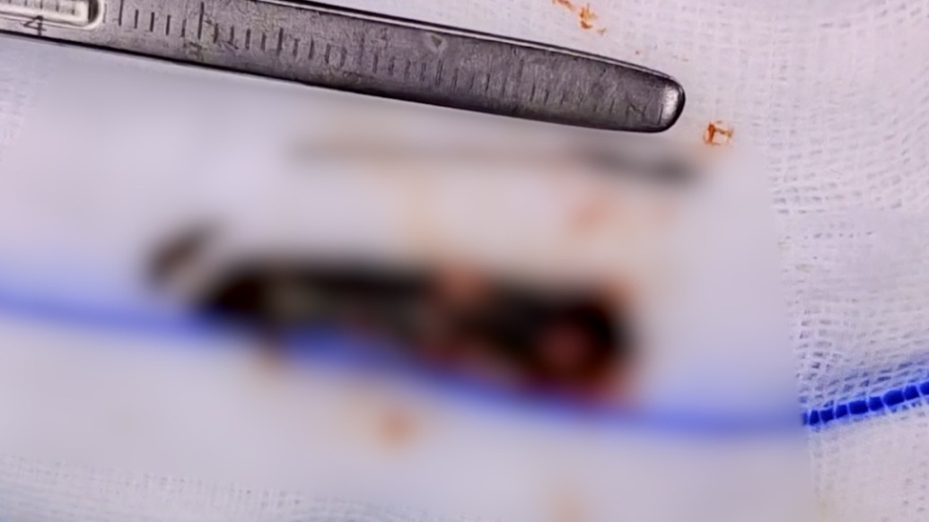 男子鼻竇炎反復發(fā)作18年，醫(yī)生手術(shù)從其鼻腔中取出一截樹枝