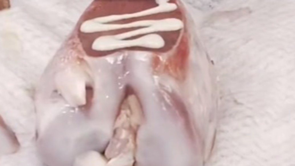 科技改變生活！全球首款“骨膠水”有望代替骨折后傳統(tǒng)金屬固定