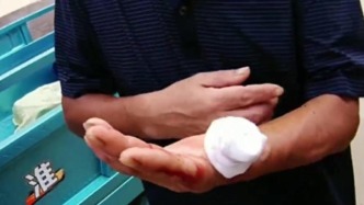 渔民海上作业断指，山东海警疾驰救援