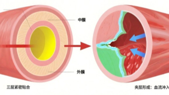 院前精准识别+绿色通道极速开启：决胜“主动脉夹层”黄金一小时